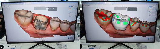 덴트버드는 치아와 잇몸의 경계, 보철물 형태를 자동으로 설정한다 / 출처=IT동아