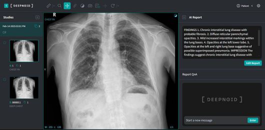 딥노이드의 흉부 엑스레이 데이터 분석 및 판독 소견서 생성 AI ‘M4CXR’, AI 판독 소견서 생성에 퓨리오사AI NPU가 도입될 예정이다 / 출처=딥노이드