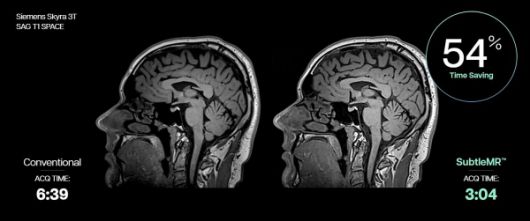 서틀엠알은 지멘스 헬시니어스 3.0T MRI ‘스카이라’(Skyra)의 뇌 시상면 방향 고해상도 3D T1 강조 영상(SAG T1 SPACE) 촬영 소요 시간(ACQ TIME)을 기존 6분 39초에서 3분 4초로 54% 단축했다.