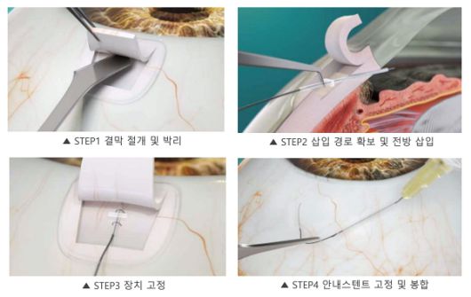 미세침습여과포수술(MIBS)에서의 에이스트림 삽입 과정