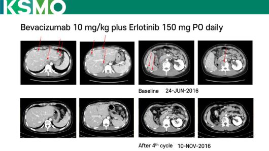 본문 사례 1번(30대 남성 신장암 환자) 허초 제도 적용 치료 예후 개선 영상의학사진. 대한종양내과학회 제공