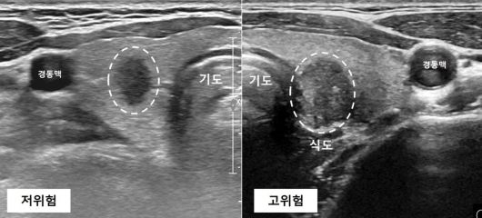 고위험과 저위험 ‘미세(갑상샘)유두암’. 서울대병원 제공