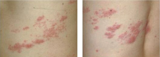 대상포진 수포는 일반적으로 붉은 반점이 몇 개 생긴 다음 여러 개가 띠 두르듯이 무리 지어 나타난다. 약 한 달 뒤 완치되지만, 상당수 환자에서 ‘대상포진 후 신경통’이 발병하기 때문에 대상포진 완치 뒤에도 주의를 기울여야 한다. 서울대병원 제공