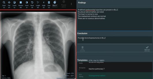 카카오브레인 AI 판독문 초안 생성 서비스가 환자의 흉부 엑스레이 사진을 보고 진단명을 분석했다. 카카오브레인 제공