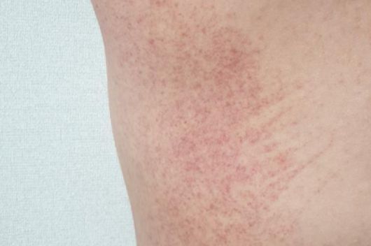 실핏줄의 약한 부위가 점처럼 터지는 점성 출혈이 발생한 모습.