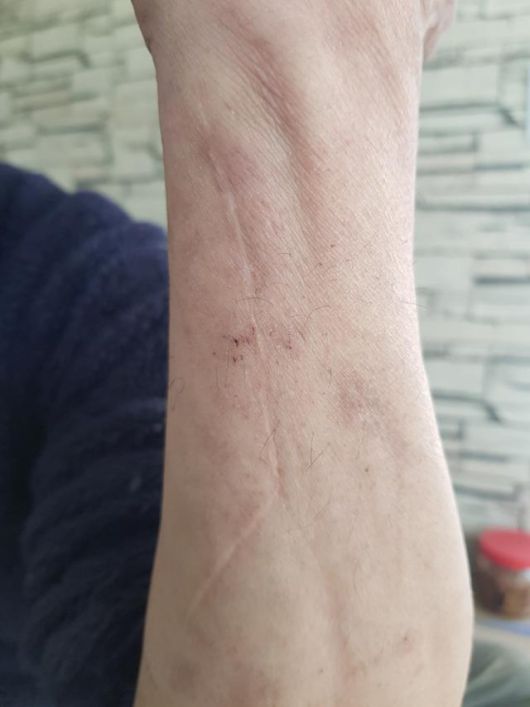 덕성원 피해자인 안종환씨가 어린 시절 폭행당한 팔의 흉터를 보여주고 있다. 부산=권경훈 기자