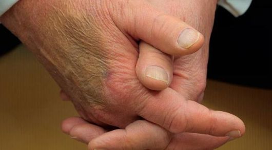 지난 2월 에마뉘엘 마크롱 프랑스 대통령과의 만남에서 포착된 도널드 트럼프 미국 대통령의 오른쪽 손등 멍자국. X 캡처