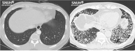 흉부 CT에서 보이는 정상 폐(왼쪽)와 특발성 폐섬유증이 진행해 폐포 사이 간질 조직이 두꺼워지고 벌집 모양을 띠는 섬유화된 폐. 분당서울대병원 제공