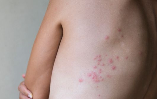 빈대에 물린 지 3일가량 지난 상처 모습. 빈대에 물리면 가려움증을 유발해 피부 감염을 일으킬 수 있다. 게티이미지뱅크