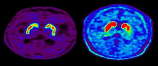 정상인의 뇌 핵의학 영상(도파민 분비 부위 활성·왼쪽)과 파킨슨병 환자의 뇌 핵의학 영상(도파민 분비 부위 퇴화).
