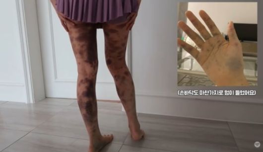 아옳이가 자신의 SNS에 올린 피멍 사진. [아옳이 유튜브 캡처]