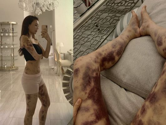 아옳이가 SNS에 올린 피멍 사진. [아옳이 인스타그램 캡처]