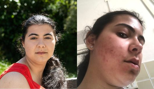 미국 출신 고고학자 카일리 디지오바니(25)는 최근 심각한 알레르기 반응인 ‘아나필락시 쇼크’ 증상이 나타나 응급실로 실려갔다. [더선]