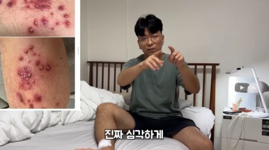 캄보디아 여행에서 저렴한 발 마사지를 받은 후 다리가 염증으로 뒤덮였다는 유튜버.  [유튜브 갈무리]