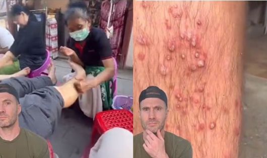 태국의 골목길에서 마사지를 받은 다음 다리에 흉측한 여드름이 생긴 남성 [조 휘팅턴 박사 소셜미디어]