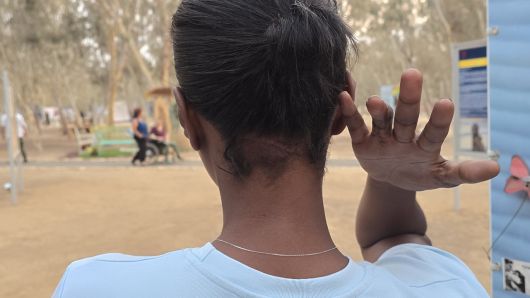 지난 11일 노바 음악 페스티벌 생존자 마잘 타자조씨가 하마스 무장대원의 소총 개머리판으로 뒷목를 맞아 상처가 난 모습 [(스데롯)=천예선 기자]