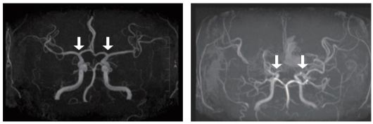[사진 왼쪽부터] 정상 및 모야모야병 환자의 뇌혈관
