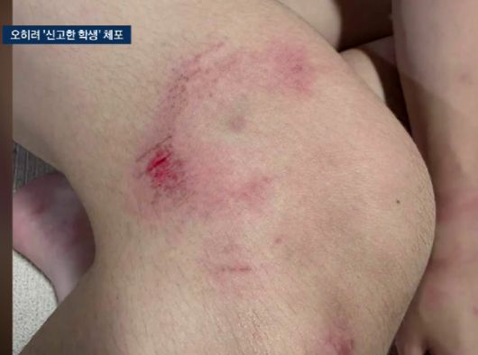 A군이 경찰의 강제 연행으로 부상을 입은 모습. [JTBC 보도화면 갈무리]