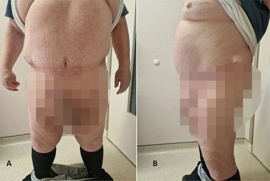 수술 후 복부 상태. (데일리스타)