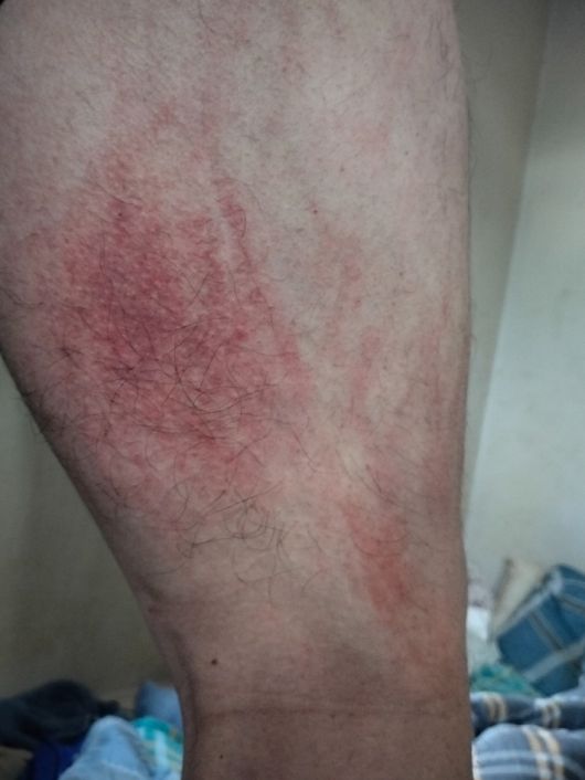 오랜 감금과 구금생활로 피부질환이 심해진 구씨의 다리.