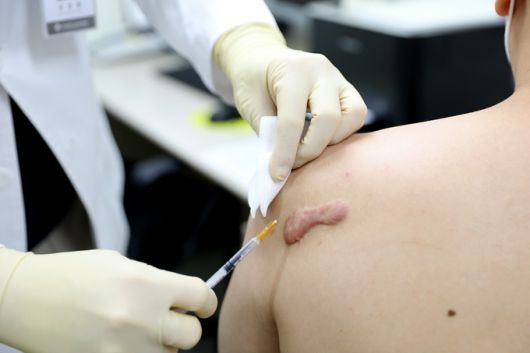 켈로이드의 근본적인 치료는 흉터 성형수술과 저선량 방사선치료다. 크기가 작거나 경미한 증상이면 흉터 안으로 스테로이드를 직접 주사하는 경우도 있다. 일산백병원 제공
