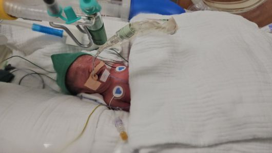 다섯쌍둥이 중 한 아이가 지난해 9월20일 태어난 직후 신생아중환자실에서 집중 치료를 받는 모습. 서울성모병원 제공