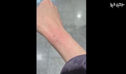 뉴스타파 측에서 공개한 기자의 빨개진 손목.