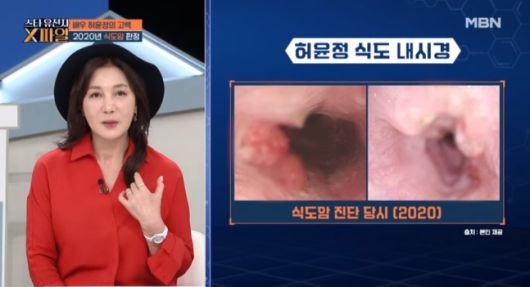 허윤정이 식도암 투병으로 고통스러웠던 시간을 고백했다. MBN ‘임성훈의 스타 유전자 X파일’ 방송 화면 캡처