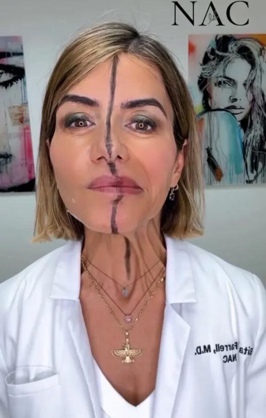 파렐 박사가 오른쪽 얼굴에만 보톡스 주사를 놓고 2주 후 그 결과를 공개하는 모습. 얼굴 좌우의 극명한 대비가 눈에 띈다. 인스타그램 캡처