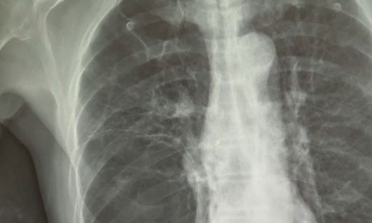 폐암 X-RAY. 연합뉴스