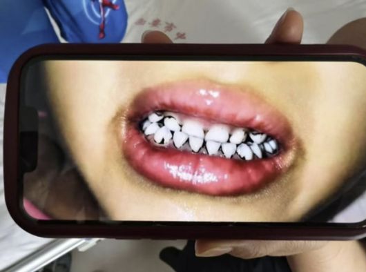 중국 간쑤성의 한 유치원에 다니던 아동이 납중독 판정을 받은 뒤, 치아 변색 등 이상 증상을 보여 부모가 병원에서 촬영한 사진. 중국 매체 지무뉴스 캡처