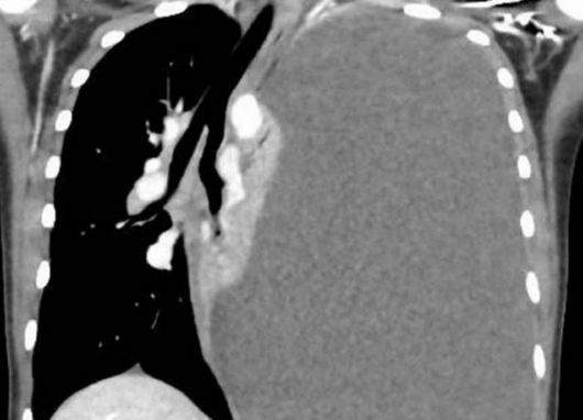 폐흡충 감염으로 대량 흉막 삼출액이 발생한 14세 여학생의 흉부 CT 사진. 의학사례보고저널 캡처