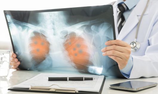 흉부 X선 관련 사진. 게티이미지뱅크