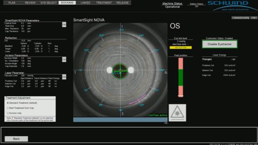 ▲스마트노바 센트렉스(CenTrax®) 기능 작동 화면(사진=눈에미소안과의원 제공)