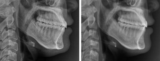 AI가 예측한 수술 후 영상(왼쪽), 수술 후 영상.