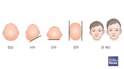 그림으로 확인할 수 있는 사두증과 단두증, 장두증의 차이. ⓒ임신영