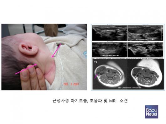 근성사경 아기모습, 초음파 및 MRI 소견. ⓒ임신영