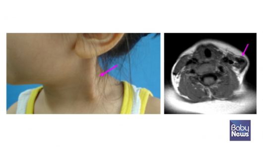 좌측 근성사경과 MRI 소견. ⓒ임신영