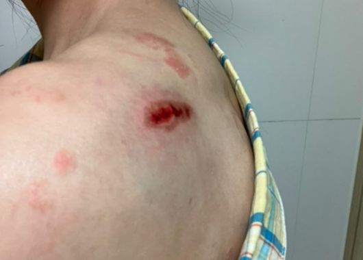 A 씨가 다친 모습. 뉴스1