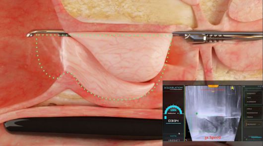 워터젯 로봇수술. 워터젯을 이용한 전립선 절제술 단면도.