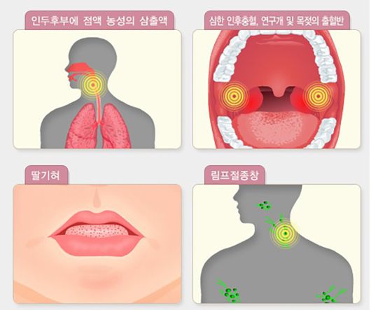 광주보건환경연구원, 법정감염병 성홍열 급증. 사진=광주보건환경연구원 제공