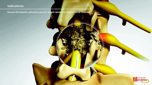 섬유성 유착으로 꼬리뼈로 진입한 카테터가 접근이 어려운 모습.