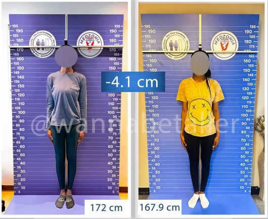 터키 병원에서 실제 ‘키 축소 수술’을 받은 미국 여성 A씨의 전후 사진. 수술 전(172㎝)에서 수술 후(167.9㎝)로 약 4.1㎝ 줄었다. [Height Reduction 공식 홈페이지]