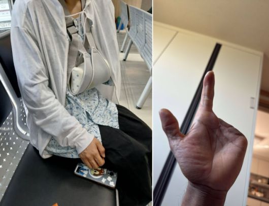 ▲안전장치 없이 일하던 중 손목이 절단된 와폰씨(왼쪽)와 손가락이 절단된 S씨의 사진. ⓒ김달성