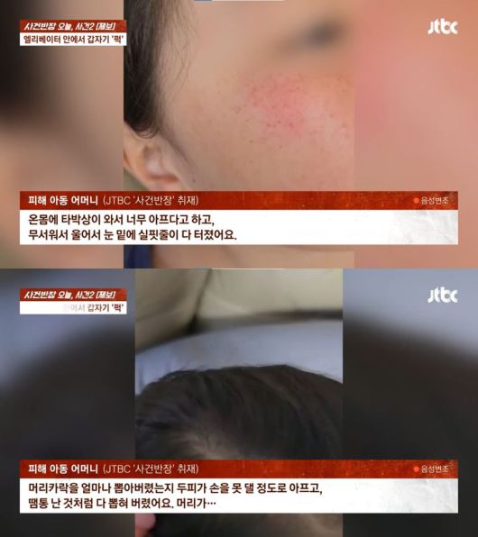 [서울=뉴시스] 20대 여성에게 폭행당해 다친 10살 초등학생.(사진=JTBC 사건반장 갈무리) *재판매 및 DB 금지