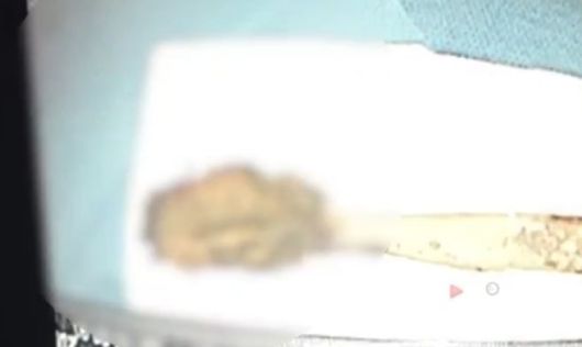 [서울=뉴시스]중국의 한 64세 남성이 극심한 가슴 통증을 호소하며 병원을 찾았다가, 무려 52년 전 삼킨 칫솔이 몸속에서 발견돼 제거되는 일이 발생했다.(사진=ycwb) *재판매 및 DB 금지