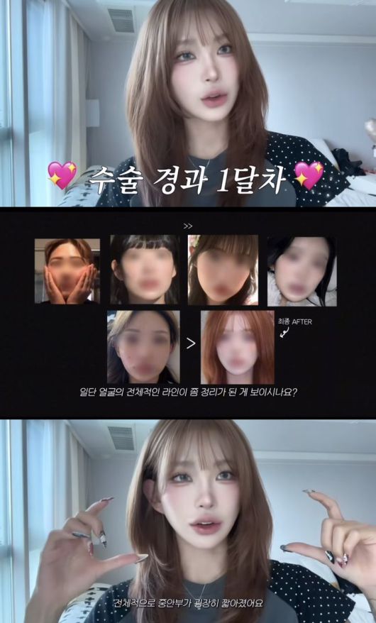 [서울=뉴시스] 최준희가 지난 8일 본인 인스타그램에 광대, 눈 성형수술 후기를 밝혔다. (사진=최준희 인스타그램 캡처) 2025.07.08. photo@newsis.com *재판매 및 DB 금지