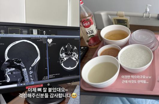 [서울=뉴시스] 모델 출신 방송인 이현이가 축구 경기 중 코뼈 골절 부상을 입었다. (사진=이현이 인스타그램 캡처) 2025.10.16. photo@newsis.com *재판매 및 DB 금지