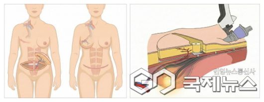 다빈치 로봇을 활용한 심하복벽 동맥 천공지 피판술(DIEP)의 개념도.(사진=연세데용인세브란스병원)