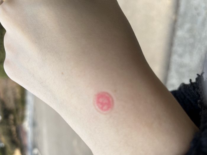 9일 제20대 대통령선거에 참여한 유모씨(30)의 손에 기표 도장이 찍혀 있다. 독자 제공